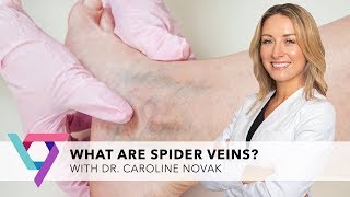 What Are Spider Veins? Vein Expert Dr. Caroline Novak Explains | Vein Treatment Center