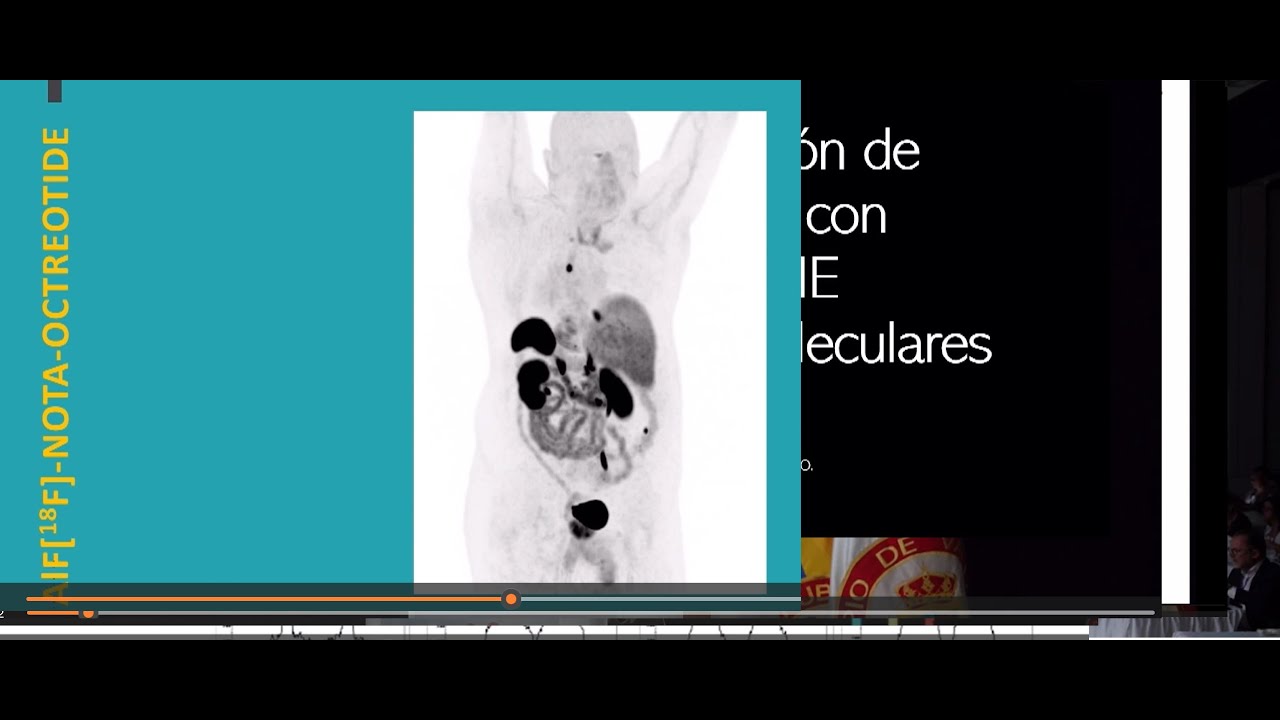 12. PET F18 NOTA Octreotide en TNE   Dr.  René Fernández. Chile