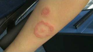 SCARY RINGWORM ON GIRL'S ARM
