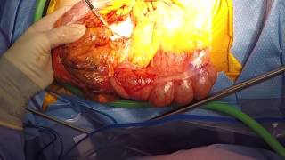 Hand Sewn Right Colectomy Hand Sewn Right Colectomy