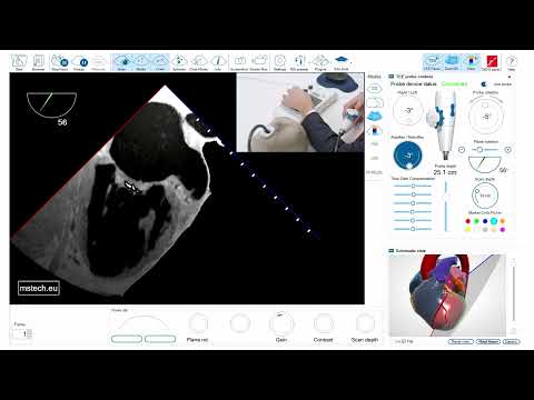 TEE assessment - left atrial appendage - important tips