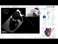 TEE Assessment Left Atrial Appendage Important Tips