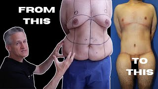 Male Body Lift and Chest Reduction After Massive Weight Loss WITH RESULTS!!!