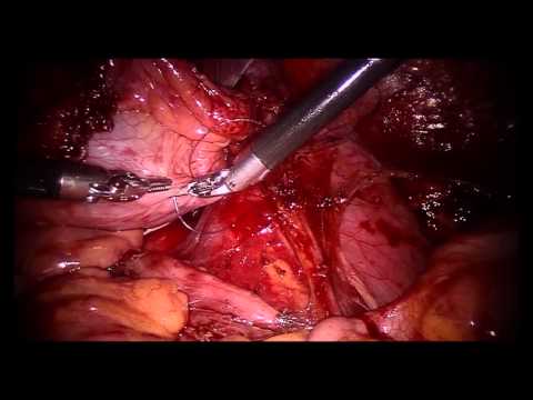 Robotic Boari Flap