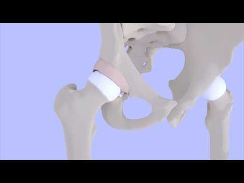 Femoroacetabular Impingement Syndrome