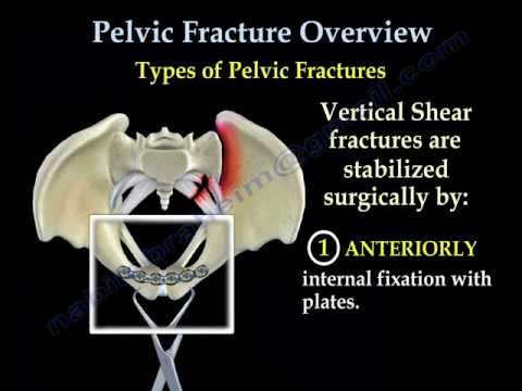 Pelvic Fracture Overview - Everything You Need To Know - Dr. Nabil Ebraheim