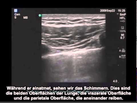 Übungen für Rückenschmerzen zurück Video Ist es möglich, nach der Operation an der Hüfte sitzt