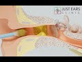 Why You Should Not Use Cotton Buds To Clean Your Ears