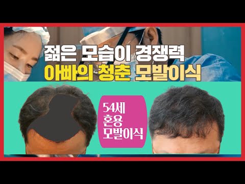 모발이식 중년모발이식 젊은 외모가 경쟁력 아빠의 청춘 혼용모발이식