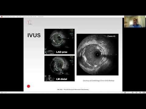 Fractured Stent in Left Main - Dr Ivan Ilic