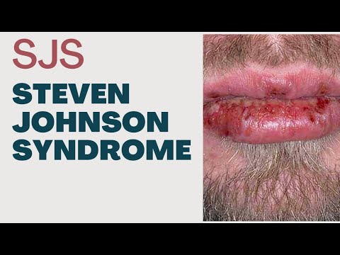 Steven Johnson Syndrome || SJS