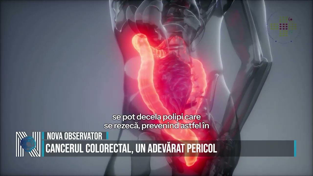 Cancerul colorectal, un adevărat pericol