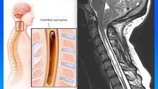 Causas y tratamientos de quistes en la columna