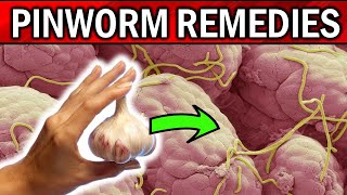 Pinworms | 8 EFFECTIVE Home Remedies for PINWORMS | Threadworms Treatment