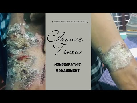 Suppressed tinea diagnosed as psoriasis