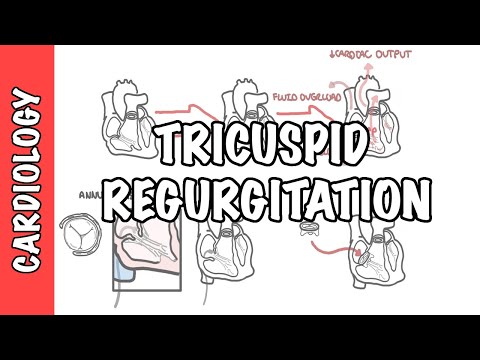 Tricuspid Regurgitation - Causes, Pathophysiology, Investigation and Treatment