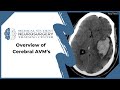 Overview of Cerebral AVM’s