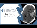 Overview Of Cerebral AVM S