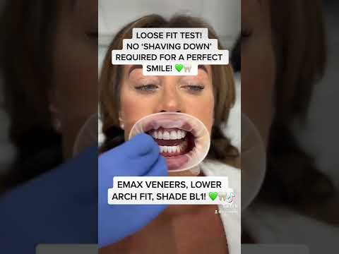 Primo Dental EMAX Veneers Loose Fit Test! #shorts