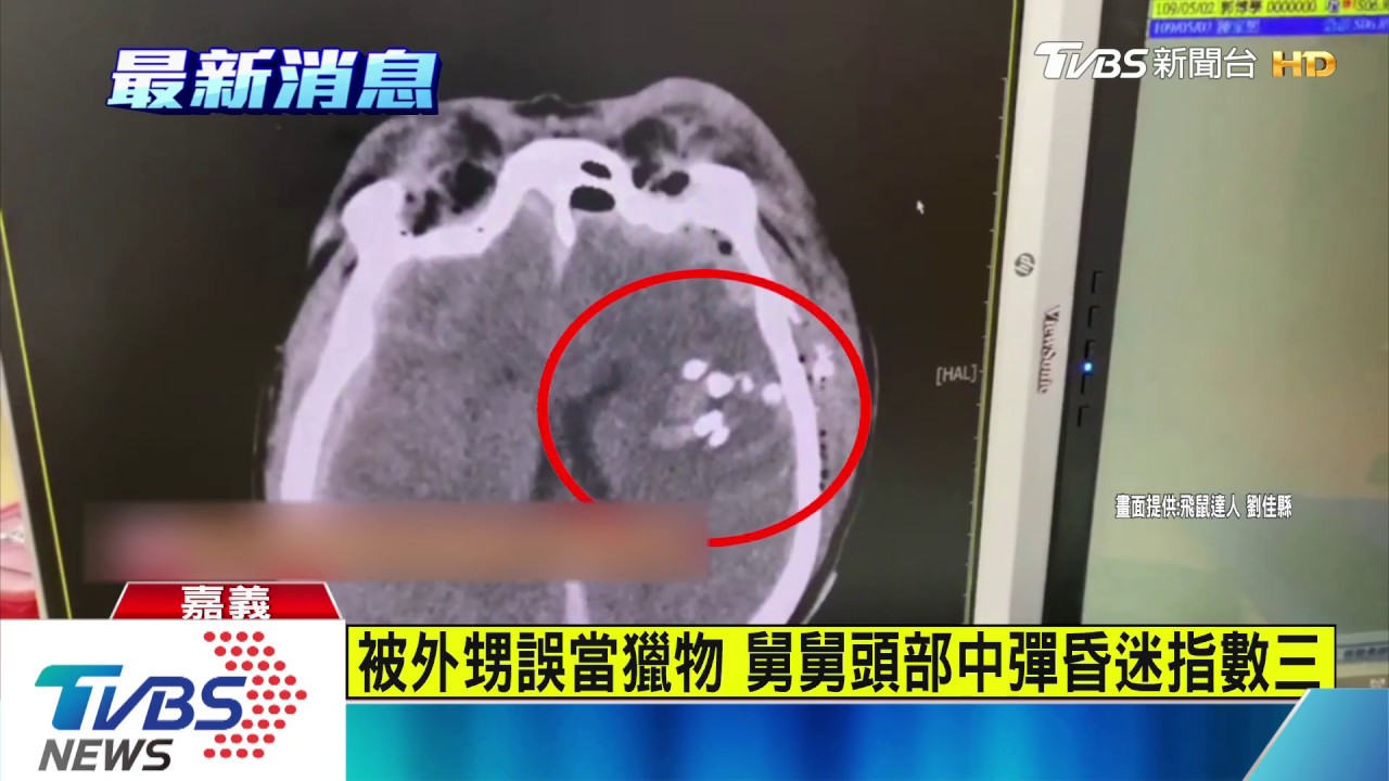 被外甥誤當獵物 舅舅頭部中彈昏迷指數三
