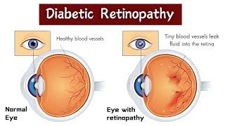 What is Diabetic Retinopathy 👁️?