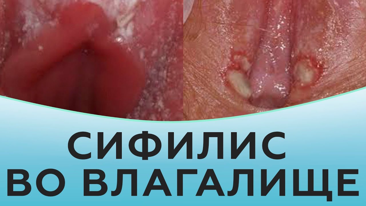 Сифилис во влагалище