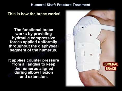 Humeral Shaft Fracture Treatment - Everything You Need To Know - Dr. Nabil Ebraheim