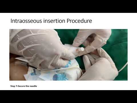 Intraosseous Insertion | Competency: PE 24.17 | Pediatrics
