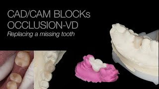 Replacing a missing tooth with edelweiss OCCLUSION-VDs & CAD/CAM BlOCKs