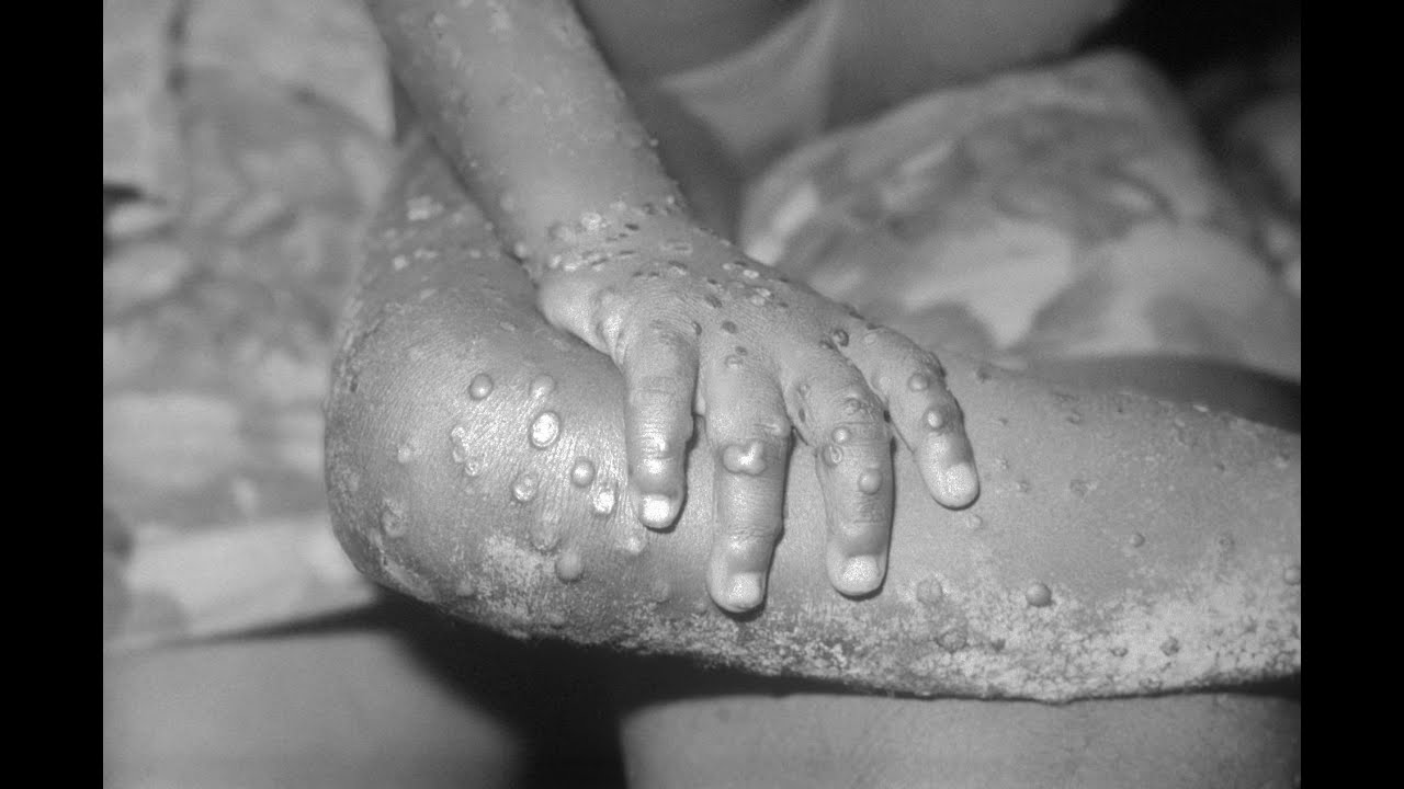 17 suspected monkeypox cases in Montreal | Officials say it's 'not highly contagious' or severe