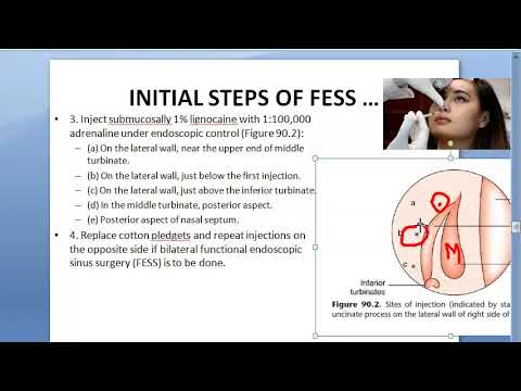 ENT FESS Surgery STEPS Approach how is it done complications post operative care operation