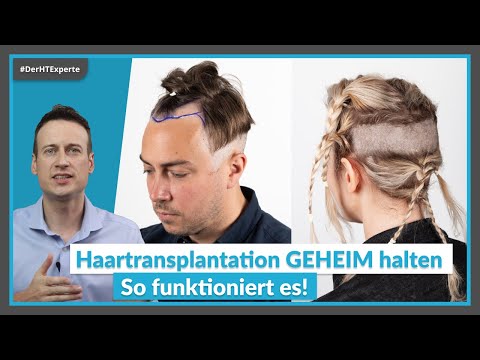 Discreet hair transplant WITHOUT SHAVING: Socially acceptable again after 2 WEEKS!