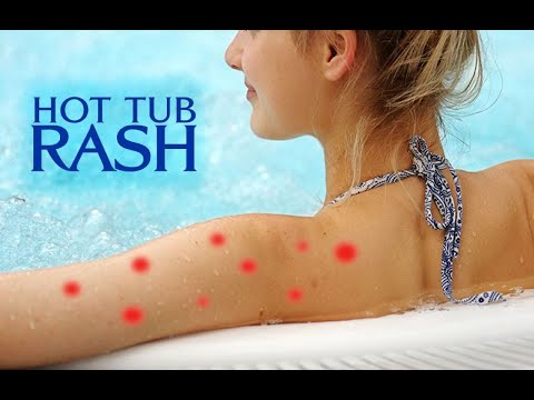 Hot Tub Rash – Causes and Solutions