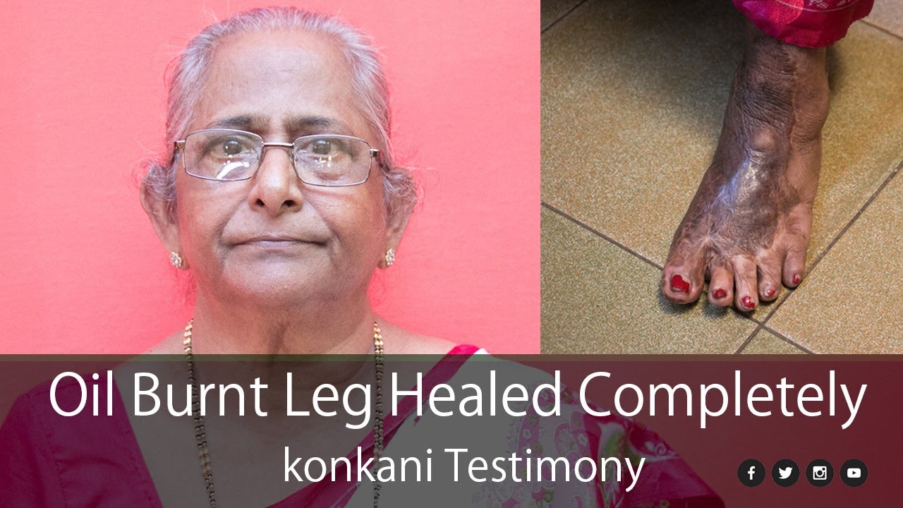 Konkani Retreat Mangalore - Oil Burnt Leg Healed Completely | Konkani Testimony