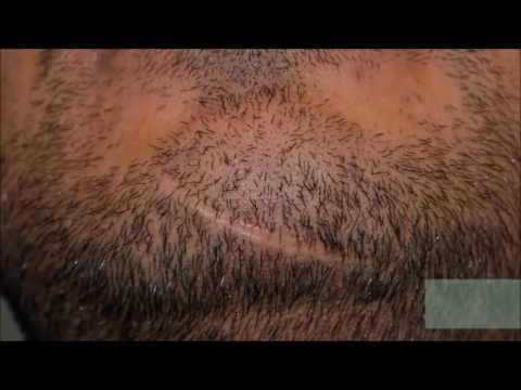 Hair transplant into Facial scar by Dr. Lindsey | McLean | VA | Virginia | Maryland | MD | DC thumbnail