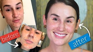 HOW I CLEARED MY ACNE + HOW I KEEP MY SKIN CLEAR | Clean Skincare + Tips for Acne