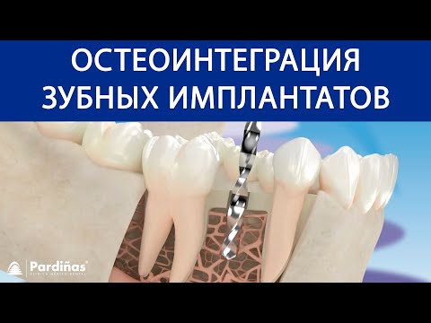 Остеоинтеграция зубных имплантатов ©