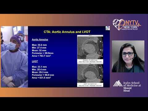 Live Case 1 - Bicuspid Aortic Valve in 77 y/o Male with Lymphoma