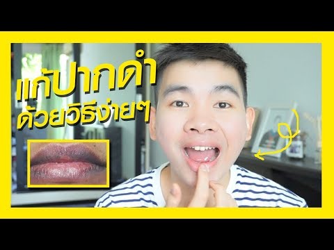 การเปลี่ยนแปลงในการตรวจโรคสะเก็ดเงิน ทะเลสาบ Saki ในโรคสะเก็ดเงิน