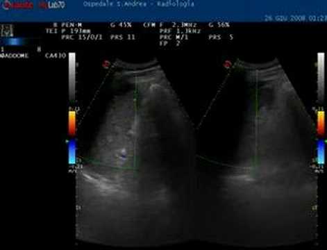 Raccomandazioni adenoma prostatico Danno o beneficio dal ciclismo per adenoma prostatico