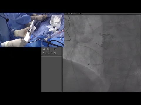 (20 Min CCC Nov '18) - Staged PCI of Severely Calcified RCA Lesions