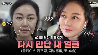 [리얼모델 VLOG] 다시 만난 내 얼굴｜풀페이스 리프팅, 지방흡입, 코 수술 6개월 리얼 후기 #일퍼센트성형외과