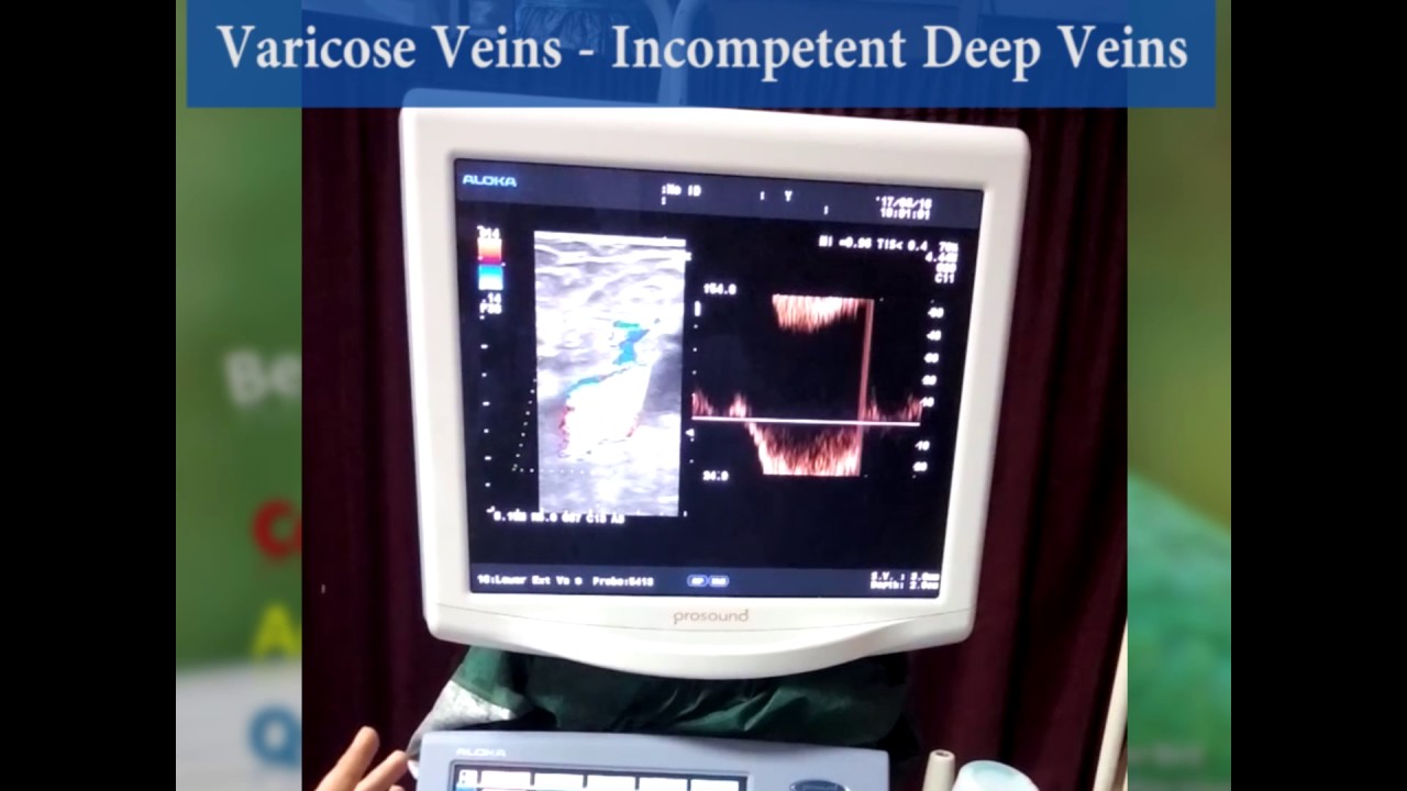 Incompetent Deep Veins