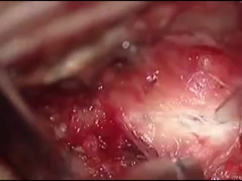 Dolore sotto la clavicola e il collo Ginnastica articolari a livello dellanca