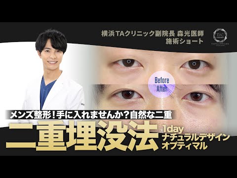 【二重整形】左右差のある目元を自然に改善!メンズ整形ならDr.モリモリにおまかせ!