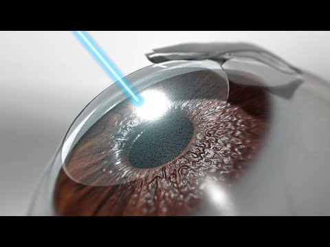 LASIK Eye Surgery (3D Animation)