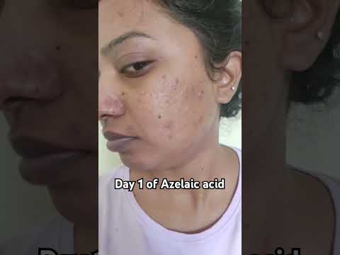 Day1 of azelaic acid #azelaicacid #acne #hyperpigmentation #acnemarks #acnescars