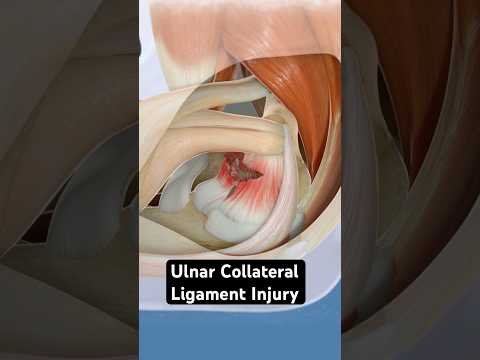 Ulnar Collateral Ligament Injury (3D animation)