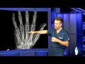 Hand Fracture Surgery