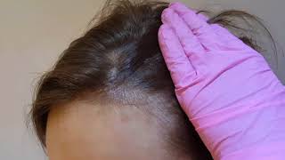 Receeding Female Hairline Microblading Micro-pigmentation by El Truchan @ Perfect Definition